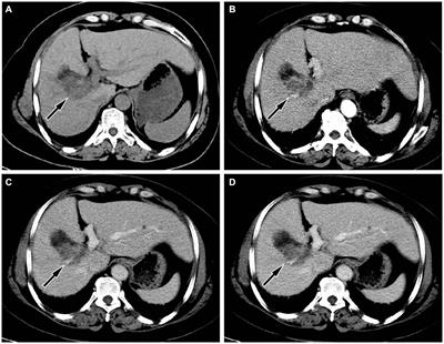 Multimodal imaging findings of primary liver clear cell carcinoma: a case presentation